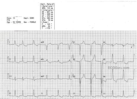 ecg porn